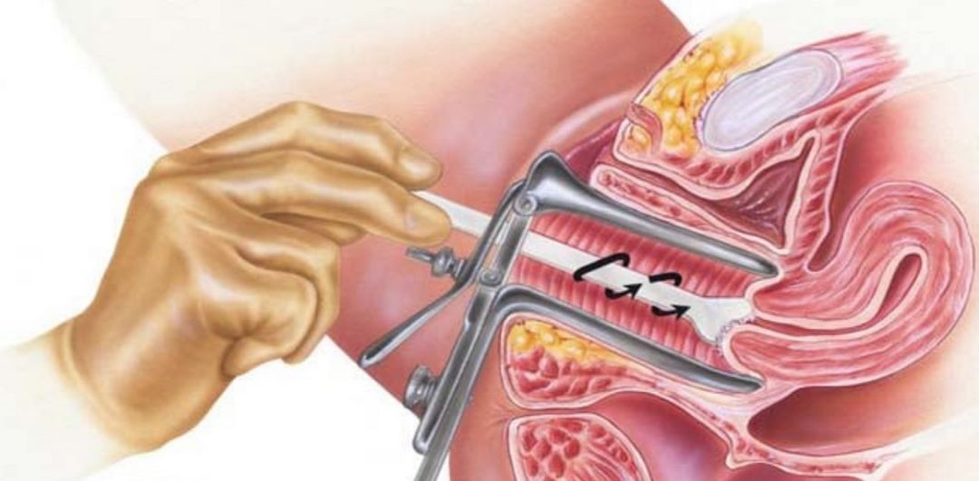 Tại sao xét nghiệm ung thư cổ tử cung lại vô cùng quan trọng?