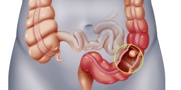 Tầm soát ung thư đại trực tràng có cách nào để thực hiện?