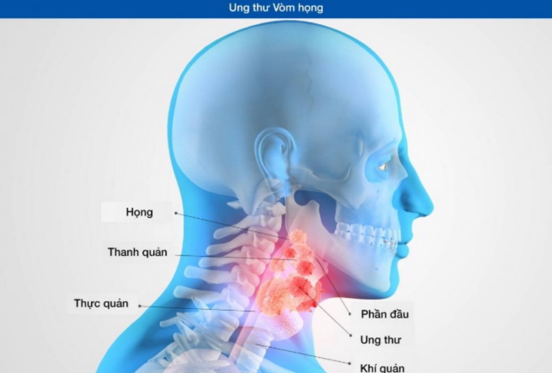 Khi nào nên tầm soát ung thư vòm họng?